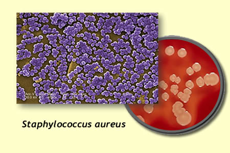 Samaritan Infectious Disease - Staphylococcus aureus Bacteremia