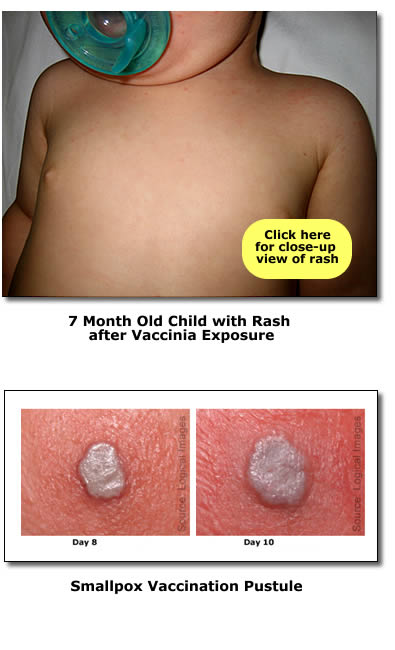 Rash after Vaccinia Exposure